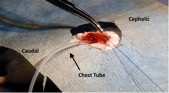 Surgical procedure diagram with chest tube insertion for medical training.