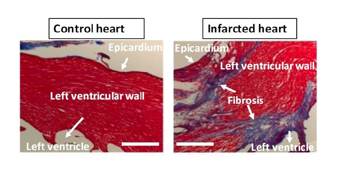 Histology comparison of control vs. infarcted heart tissue; fibrosis visible; slide analysis.