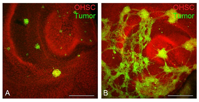 Histological microscopy of tumor development in OHSC, highlighting cellular structure and interaction.