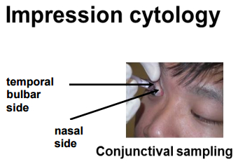 Impression cytology method; conjunctival sampling; diagram labeled temporal, nasal sides.