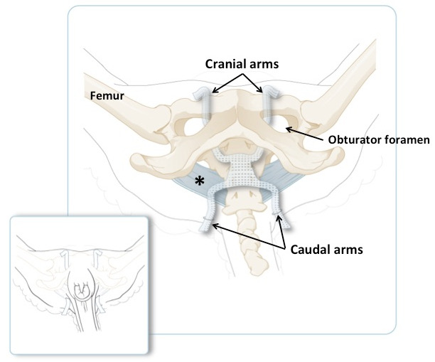 Pelvic anatomy diagram; labeled femur, obturator foramen, highlighting mesh placement and structure.