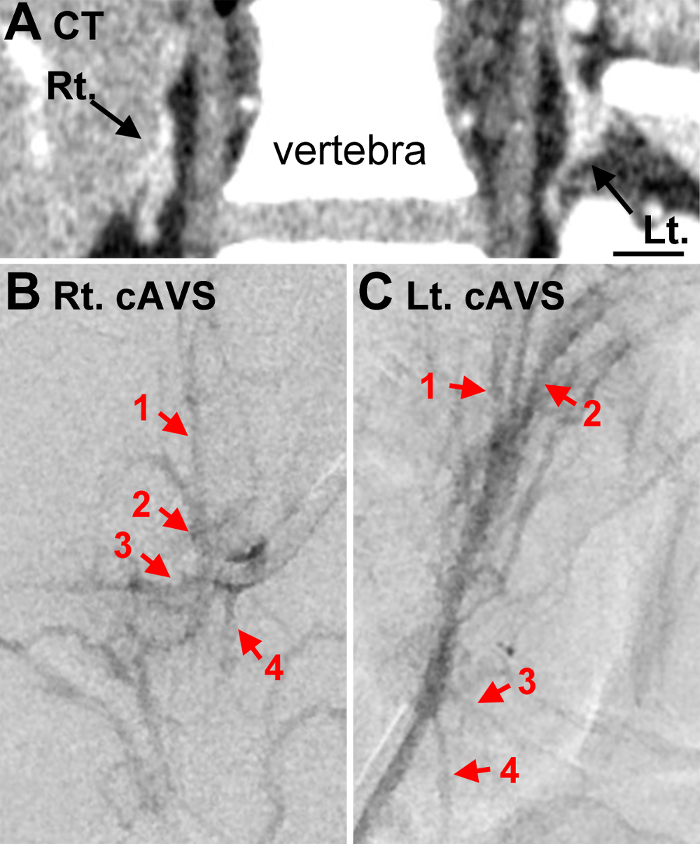CT scan and angiography images of vertebral region for vascular assessment and comparison.
