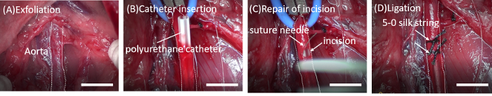 Aortic procedure steps with catheter insertion and incision repair, using suture needle and silk string.