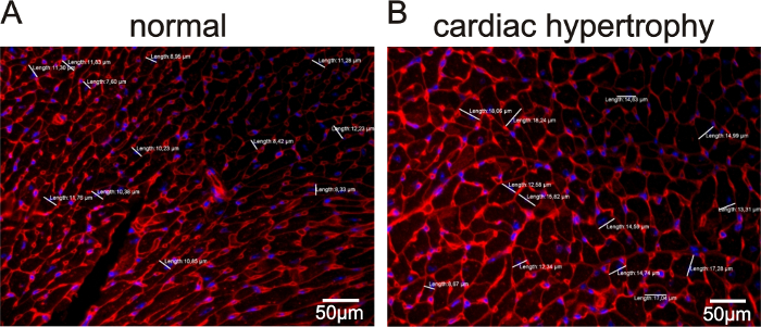 Muscle fibers comparison in microscopy images; normal vs cardiac hypertrophy; cellular analysis.