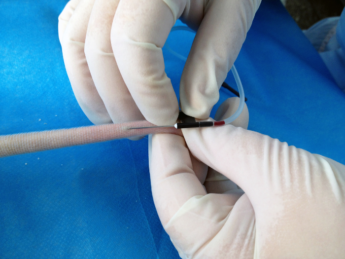figure-results-2 Catheter insertion procedure; medical gloves, surgical method, sterile technique, close-up view.