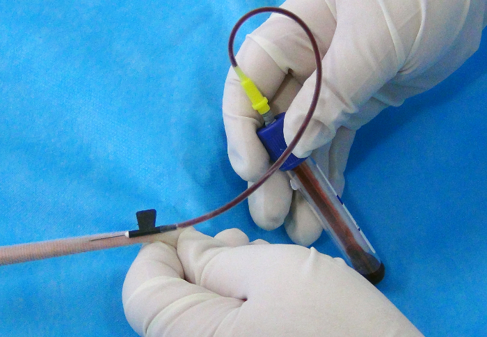 figure-results-3 Blood sample collection, phlebotomy procedure, gloved hands, tube, clinical analysis setup.