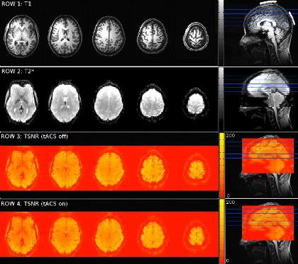 figure-results-3 Brain MRI with T1, T2* imaging; TSNR maps, tACS on/off; neurological imaging analysis.
