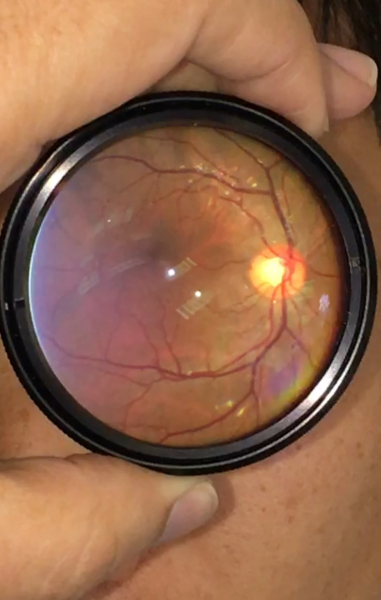 Ophthalmology exam; retinal fundus image; eye inspection with ophthalmoscope; medical diagnosis.