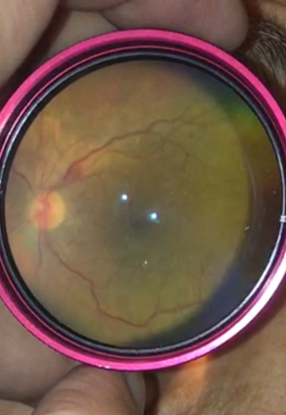 Ophthalmoscope retinal eye exam, showing optic disc and blood vessels in medical diagnosis.