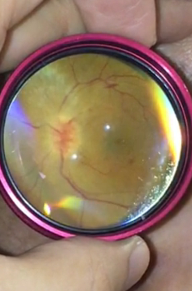 Ophthalmoscopy examination, retinal image analysis, optic nerve evaluation, eye health diagnostics.