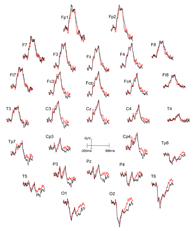 EEG brainwave data analysis chart; electrodes Fp1, Fp2; signal comparison; neural activity visualization.