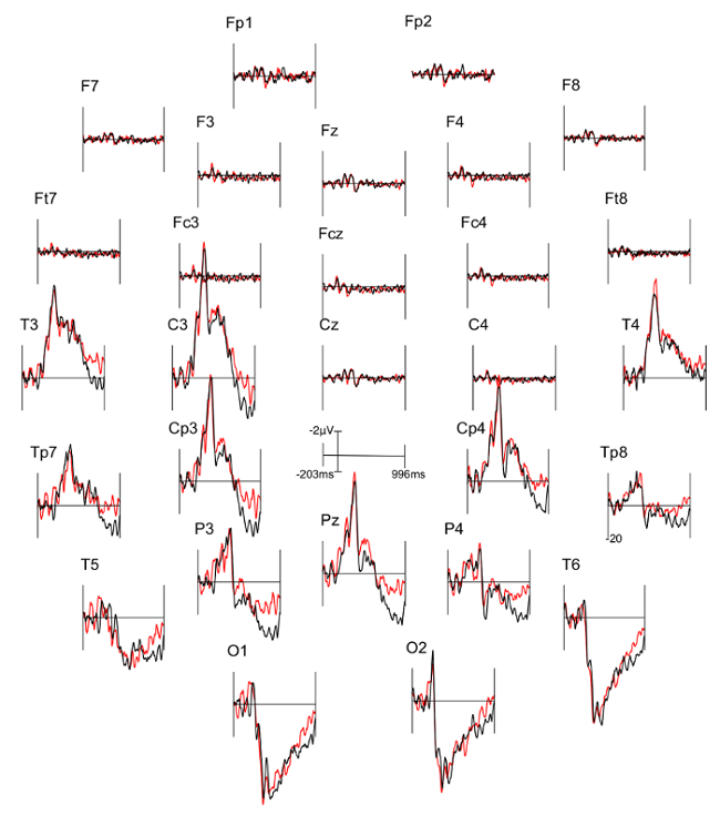 EEG waveform chart; brain signal analysis; electrode data visualization; neurological research.
