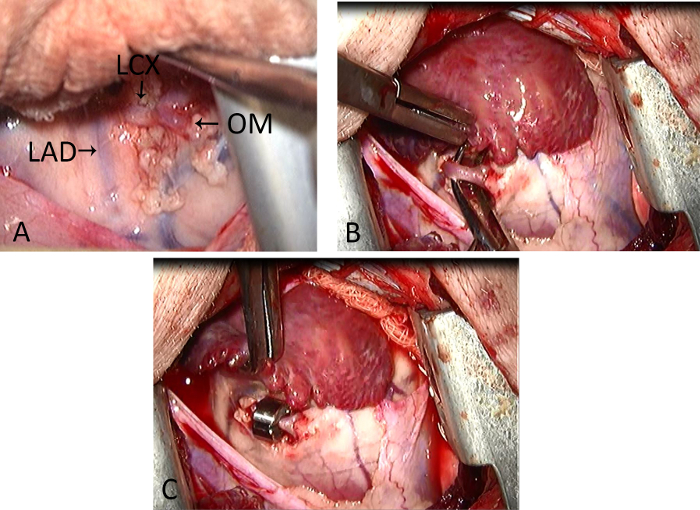 Coronary artery bypass grafting surgical procedure, heart anatomy marked; medical operation photos.