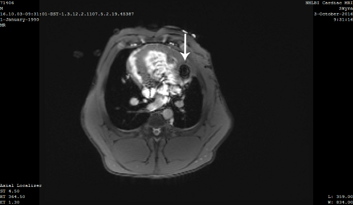 Abdominal MRI scan showing tumor; diagnostic imaging, axial view, medical analysis.
