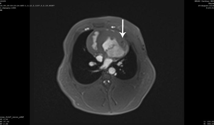 MRI scan, chest cross-section with arrow indicating possible abnormality for diagnostic analysis.