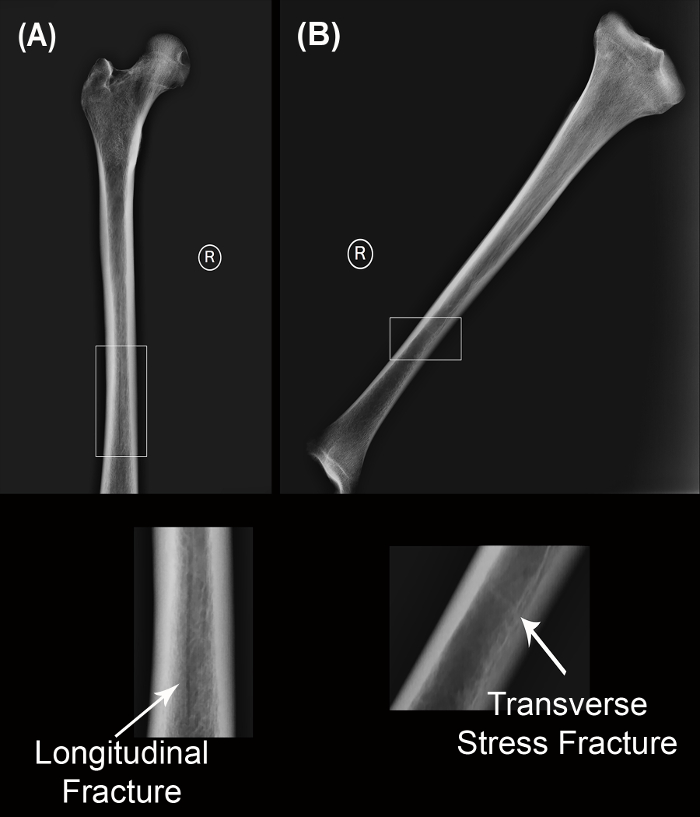 Bone Remains Scanning Skeletal Remains for Bone Mineral Density in Forensic Contexts