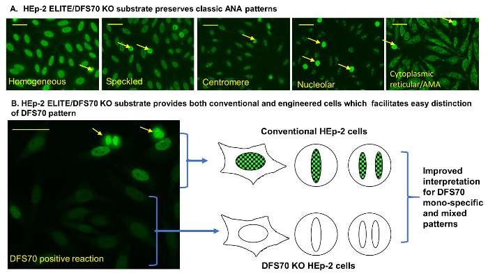 figure-results-2 HEp-2 substrate ANA pattern analysis; microscopy, pattern identification, DFS70 cell comparison.