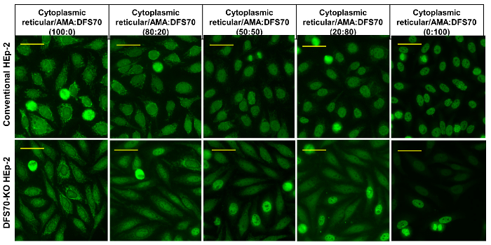 figure-results-7 Hep-2 cell immunofluorescence, cytoplasmic reticular pattern, DFS70 antibody, microscopy results.