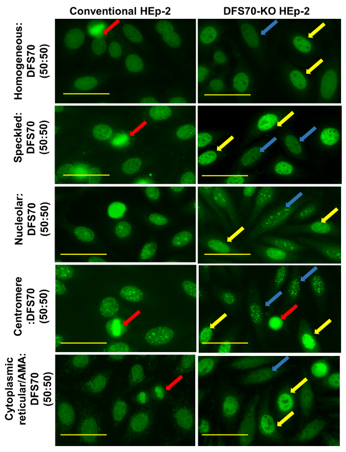 figure-results-8 Fluorescence microscopy comparison of HEp-2 and DFS70-KO cells, analyzing nuclear staining patterns.