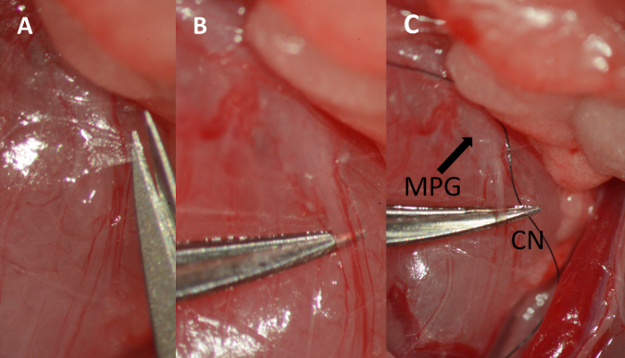 figure-results-6 Surgical procedure diagram; nerve dissection; tools; labels MPG, CN; educational use.