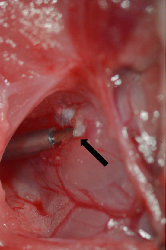 figure-results-8 Surgical method with arrow indicating incision point; dissection procedure, anatomical study.