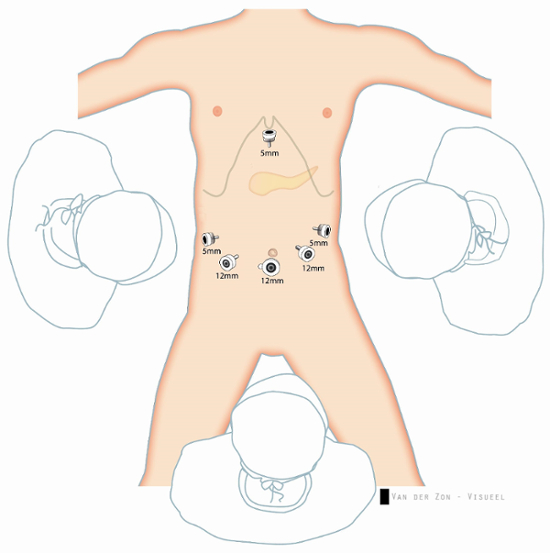 Diagramma di posizionamento della porta per laparoscopia; procedura chirurgica, configurazione dello strumento, porte da 5 mm e 12 mm.