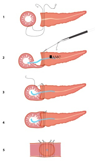Diagramma del processo di legatura del dotto pancreatico con metodo chirurgico graduale per lo studio del pancreas.