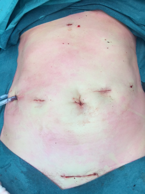 Procedura chirurgica, siti di incisione addominale, preparazione alla chirurgia laparoscopica, studio della tecnica medica.