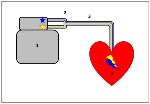 Pacemaker diagram; heart signaling process; device connected to heart for rhythm regulation.