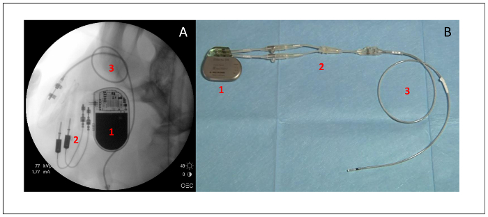 X-ray and device setup of cardiac pacemaker illustrating leads and battery placement.