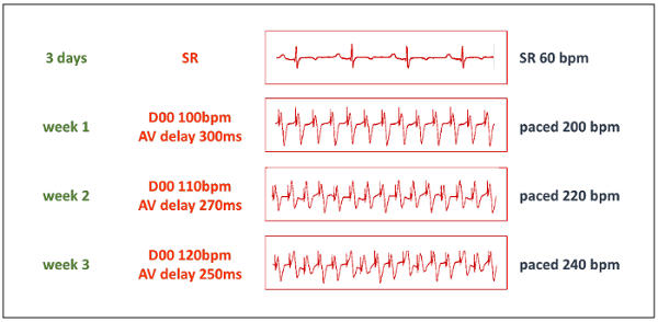 ECG charts showing heart rate variations over three weeks; bpm changes with AV delay adjustments.
