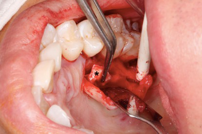 figure-results-1 Dental surgery, tooth extraction, close-up, dental instruments, oral cavity, surgical procedure.
