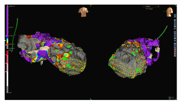 figure-results-4 3D cardiac mapping diagram showing voltage distribution for electrophysiological analysis.