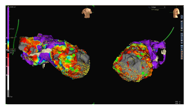 figure-results-5 Cardiac electrophysiology mapping diagram; 3D voltage distribution analysis; heart arrhythmia study.