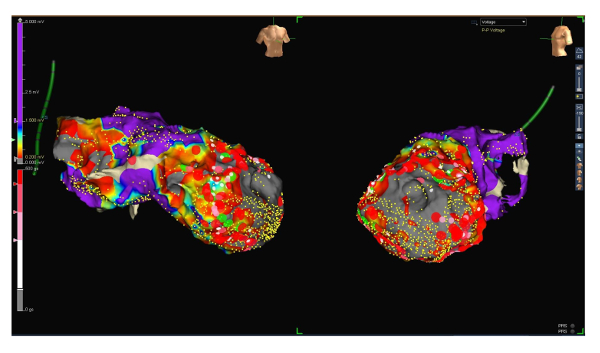 figure-results-6 3D cardiac voltage mapping; electrophysiology analysis; heart model visualization; medical research.