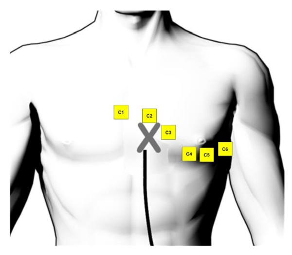 figure-results-1 Chest lead placement diagram for ECG electrode configuration on human torso, labeled C1-C6.