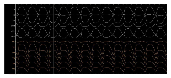 figure-results-3 ECG waveform chart showing lead variations for cardiac rhythm analysis.