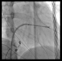 Angiography image, cardiac catheterization showing coronary arteries for blood flow analysis.