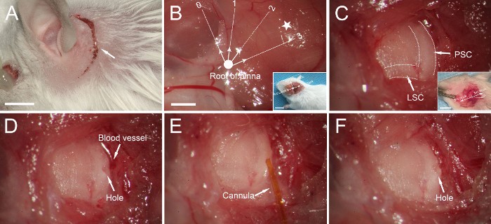 Surgical procedure diagram with labeled cannula insertion and blood vessel exposure.