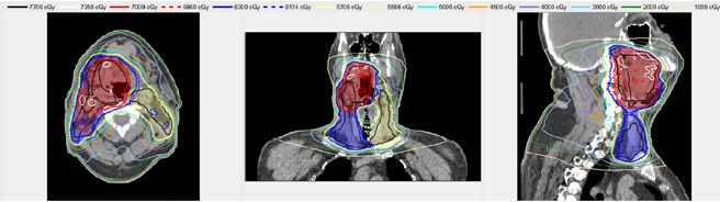 Radiation dose distribution, color map on CT scans, axial, coronal, sagittal views, cancer treatment planning.
