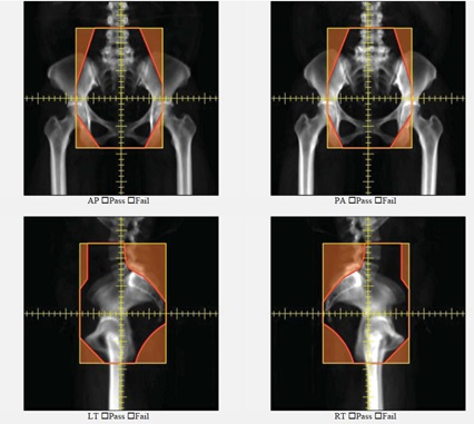 X-ray image analysis, pass/fail assessment, orthopedic evaluation, hip alignment, medical imaging.