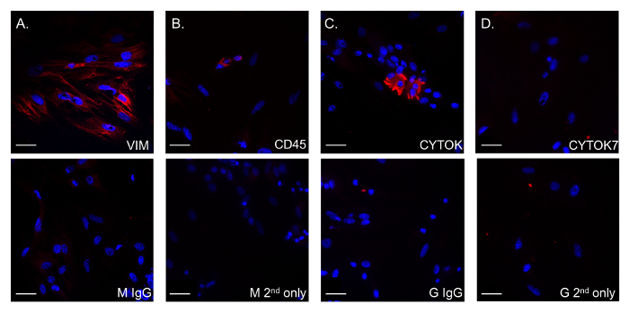 Immunofluorescence assay results; VIM, CD45, CYTOK detection; microscopy image; cell staining.