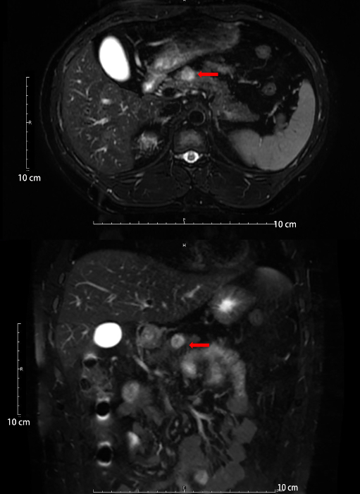 로봇 중앙 Pancreatectomy 문 합 엔드 투 엔드의 응용 프로그램