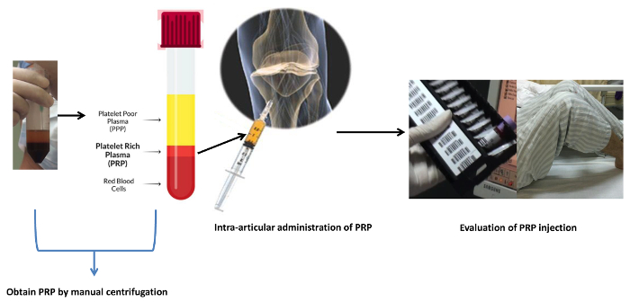 figure-results-1 PRP process: manual centrifugation, intra-articular injection diagram, PRP treatment evaluation.
