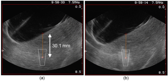 figure-results-3 Ultrasound scan diagram, measuring internal structure at 30.1 mm; comparative analysis shown.