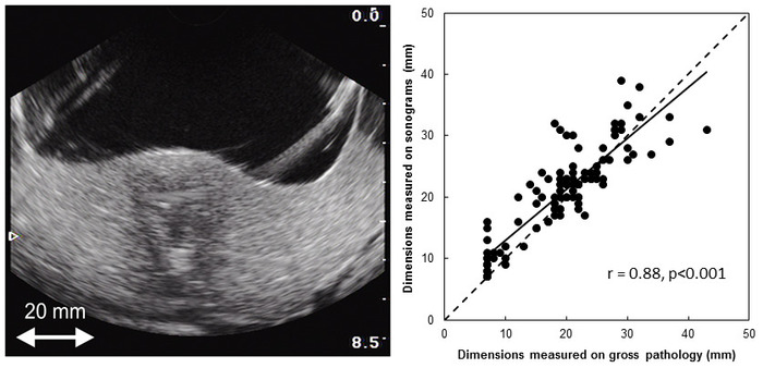figure-results-4 Ultrasound and graph comparing sonogram vs pathology dimensions, r=0.88, p<0.001 correlation.