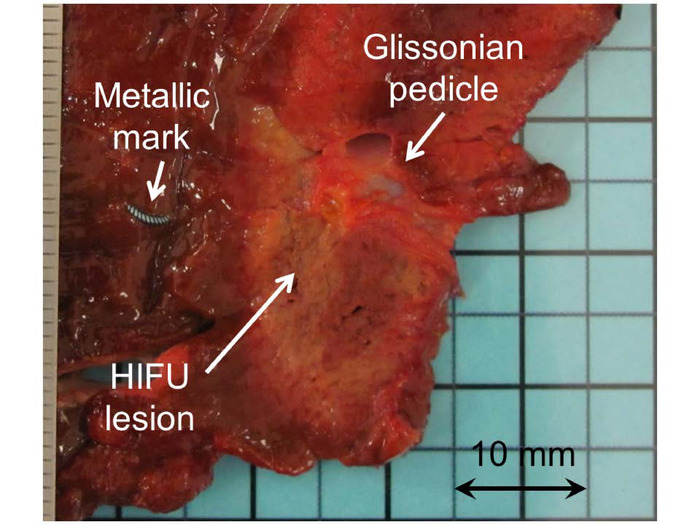 figure-results-6 HIFU lesion identification on liver slice; metallic mark, Glissonian pedicle; medical imaging analysis.