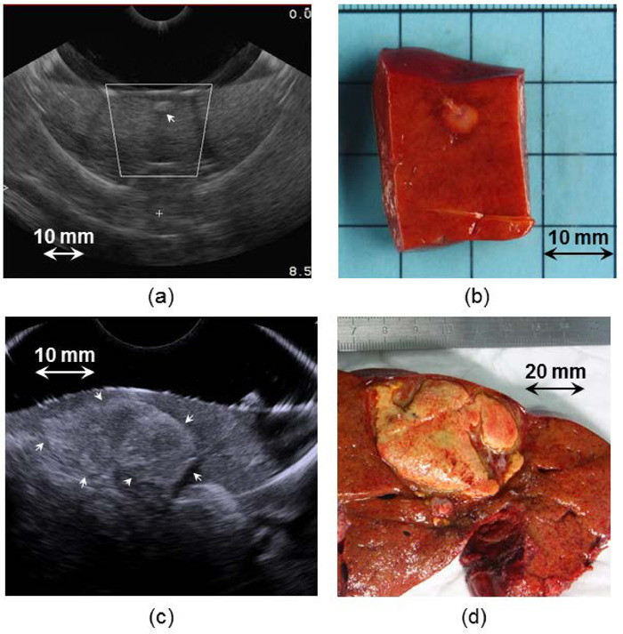 figure-results-7 Ultrasound and excised tissue comparison, tumor identification, diagnostic imaging, scale in mm.