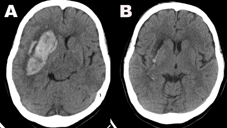 CT scan comparison; brain hemorrhage in image A, normal brain in image B; diagnostic imaging.