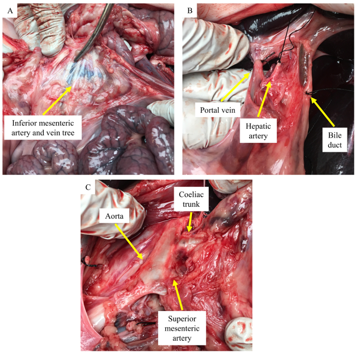 Dissection diagram showing vascular anatomy with arteries, veins, and bile duct highlighted.